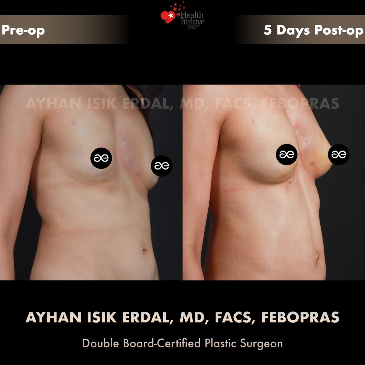 Left oblique view, pre-op and 5 days post-op — fat grafting result