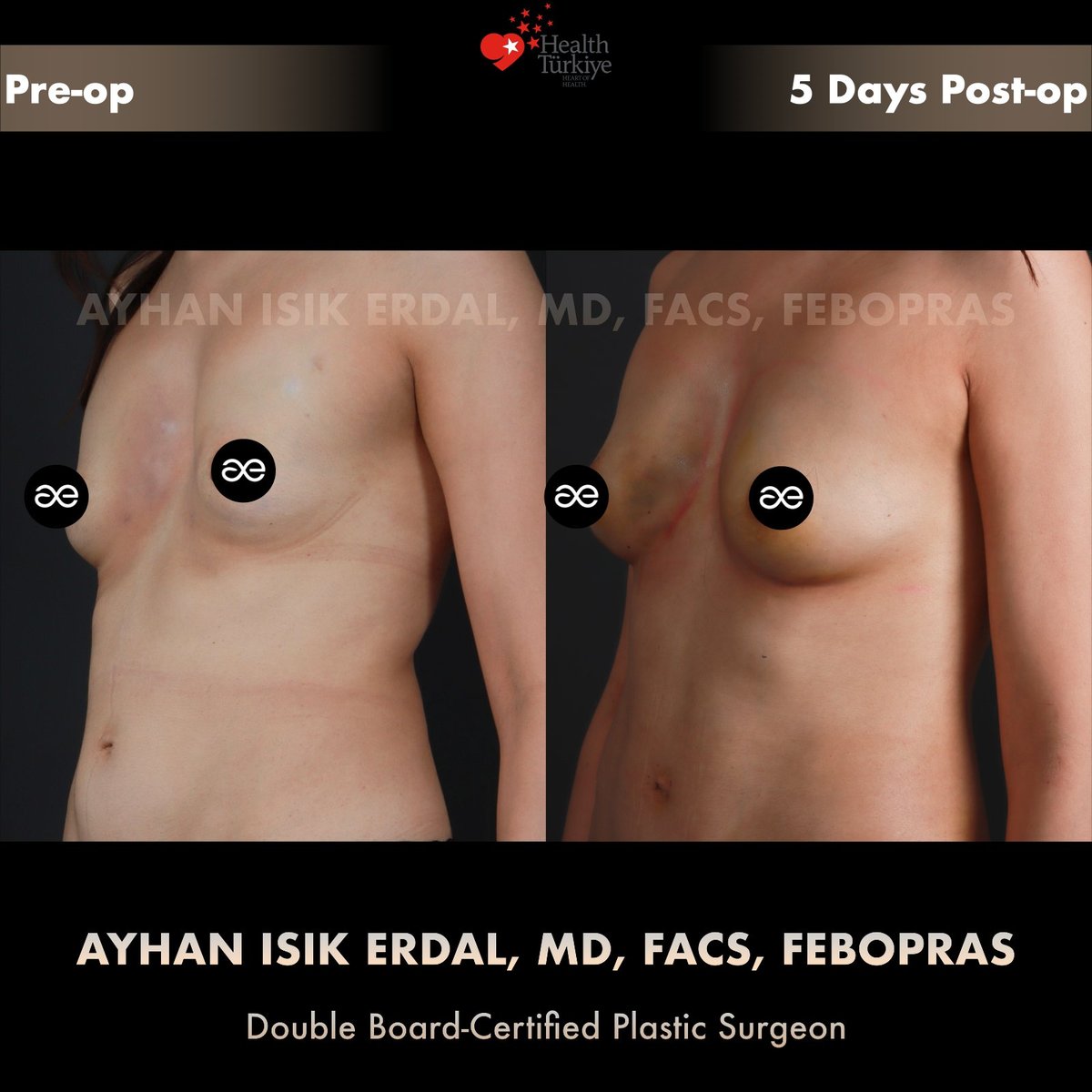 Right oblique view, pre-op and 5 days post-op — autologous fat transfer
