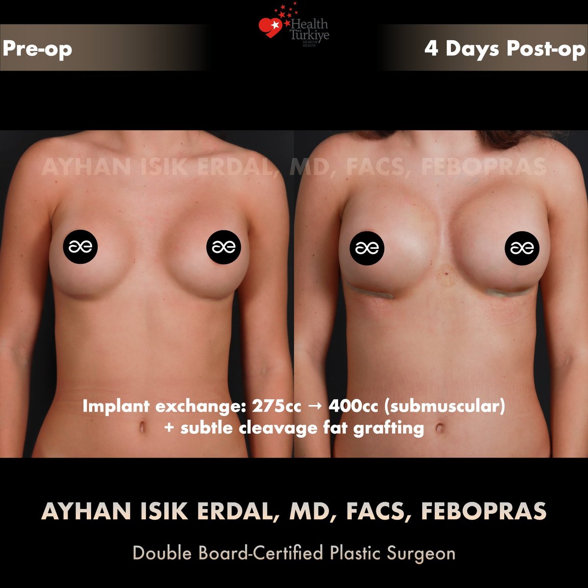 Pre-op and Day 4 post-op result, hybrid implant exchange with cleavage fat grafting