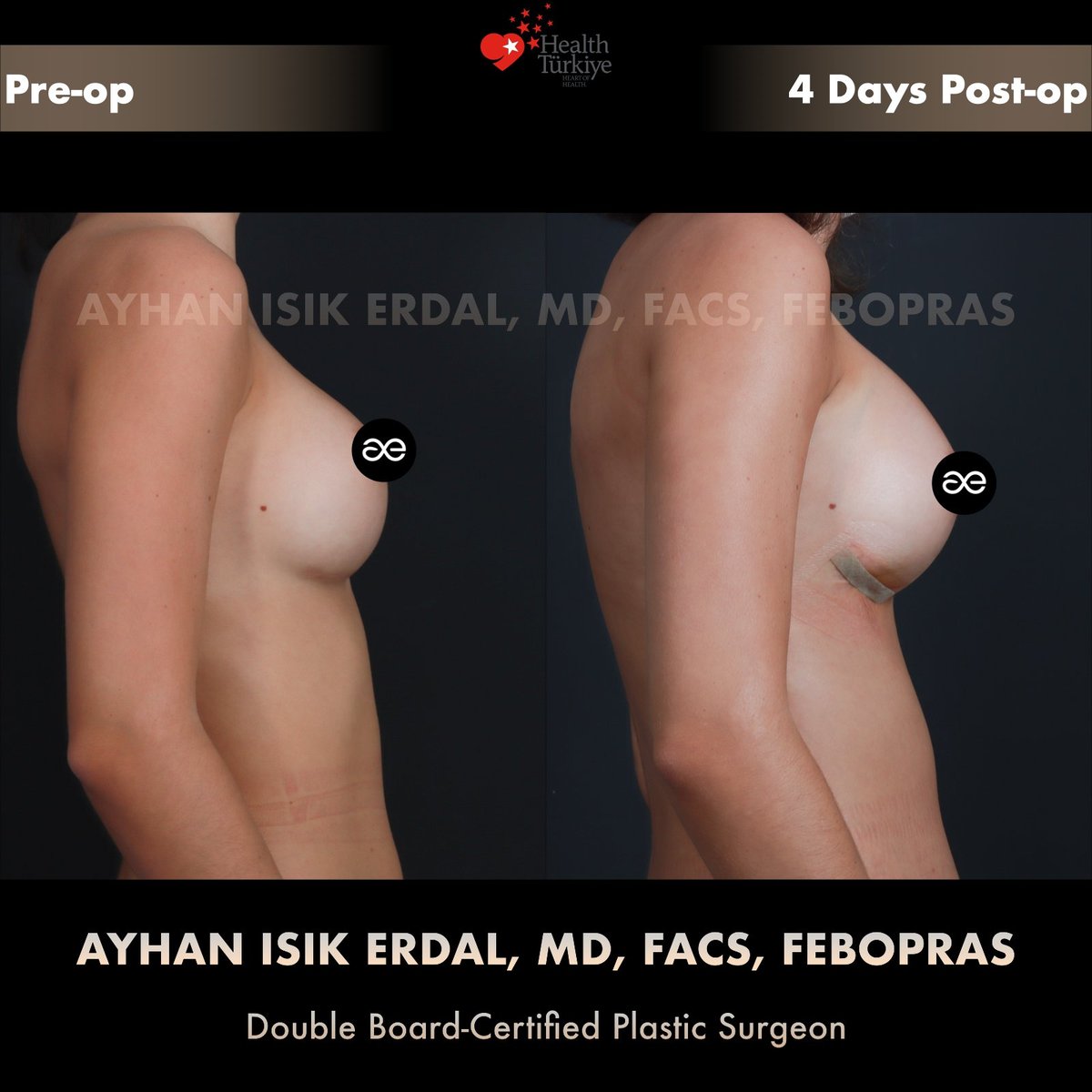 Lateral view, pre-op and 4 days post-op — implant size increase