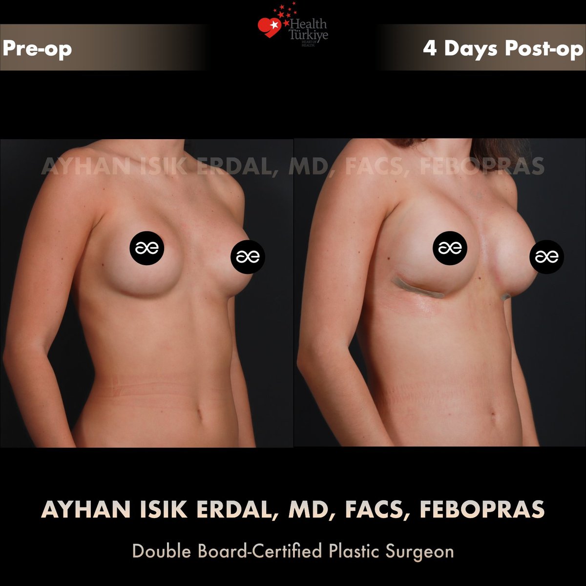Oblique view, pre-op and 4 days post-op — hybrid breast augmentation