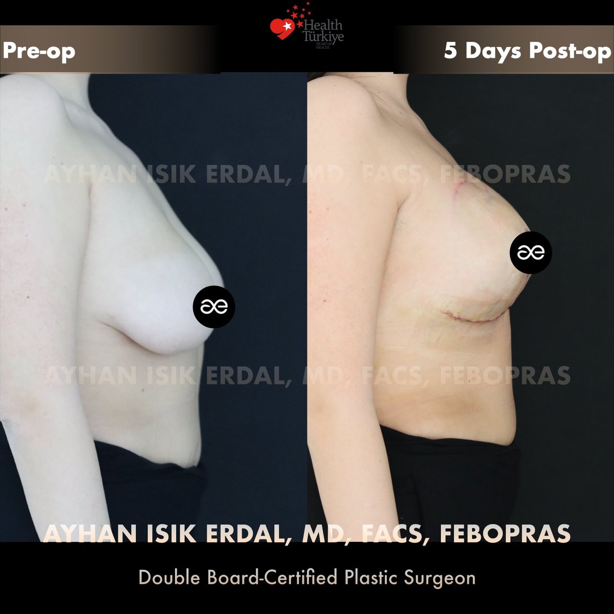 Lateral view, pre-op and 5 days post-op — superior-pedicle inverted-T reduction-augmentation mastopexy
