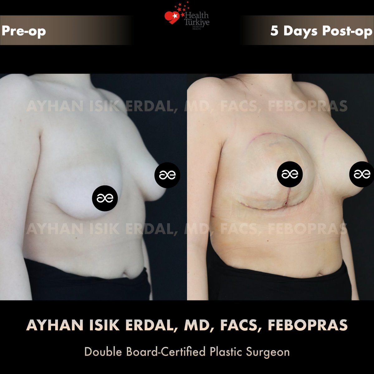 Oblique view, pre-op and 5 days post-op — bilateral asymmetric breast surgery